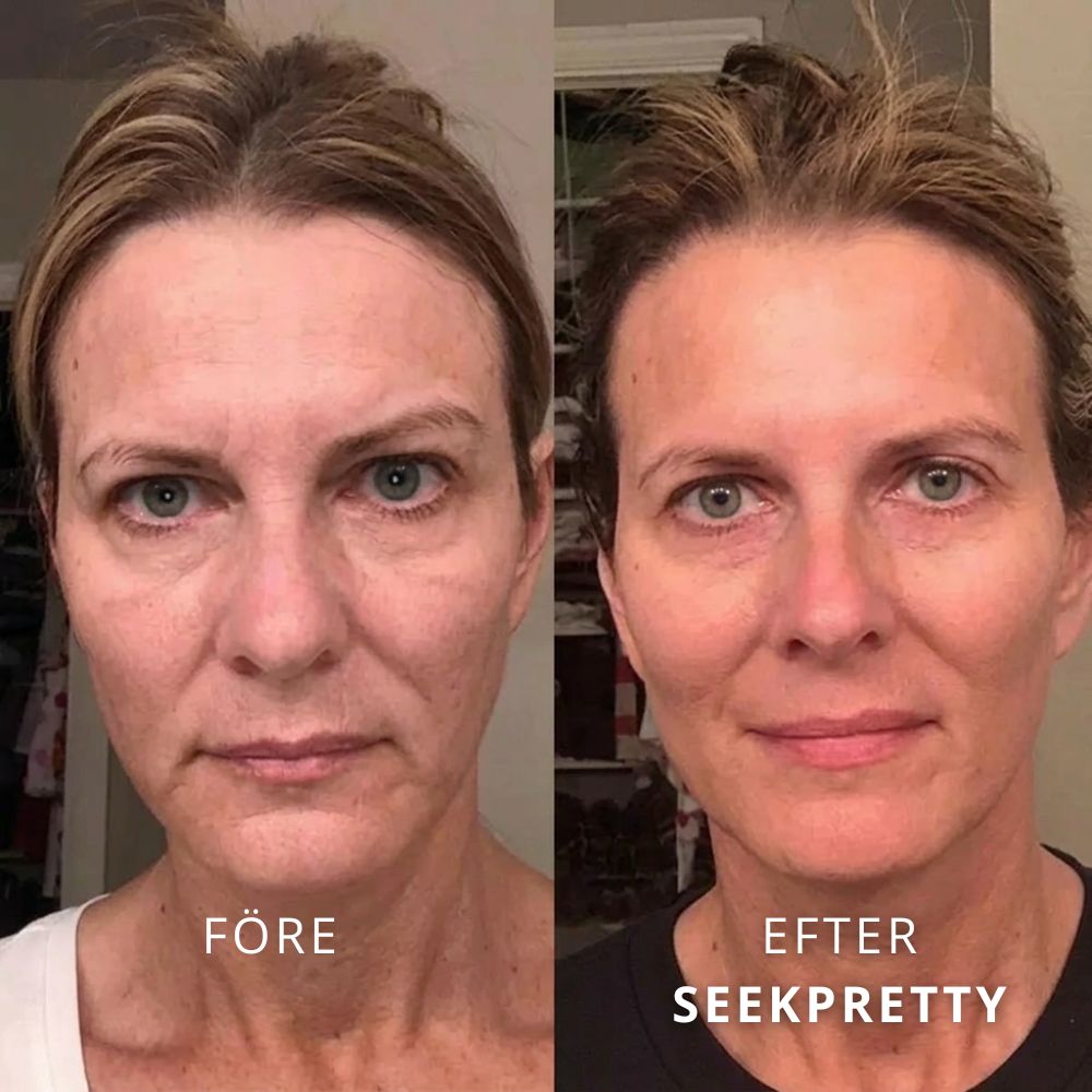SeekPretty Micro Infusion System™