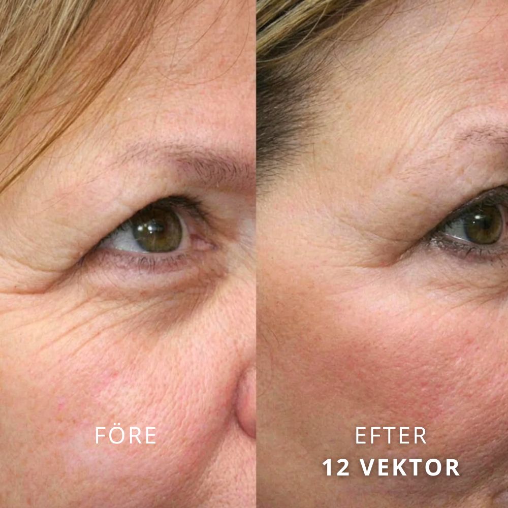 SeekPretty Micro Infusion System™