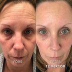 SeekPretty Micro Infusion System™