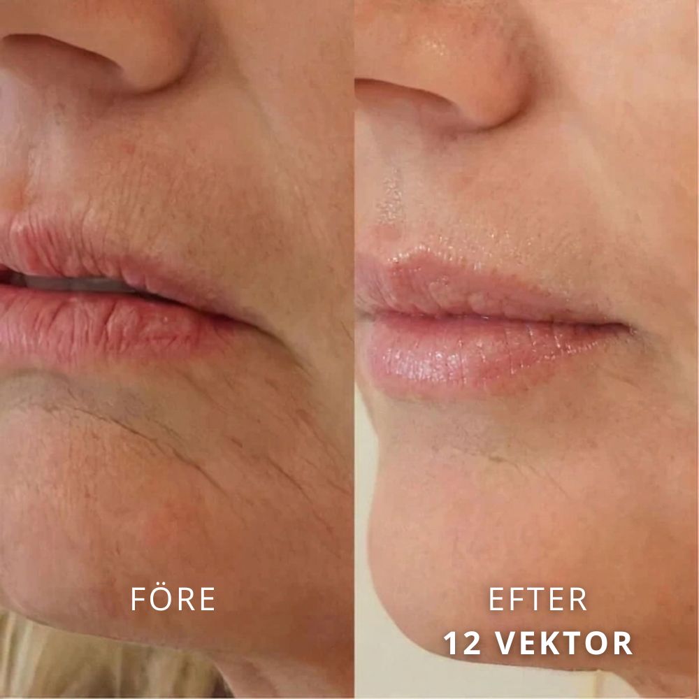 SeekPretty Micro Infusion System™