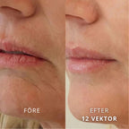 SeekPretty Micro Infusion System™