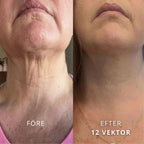 SeekPretty Micro Infusion System™